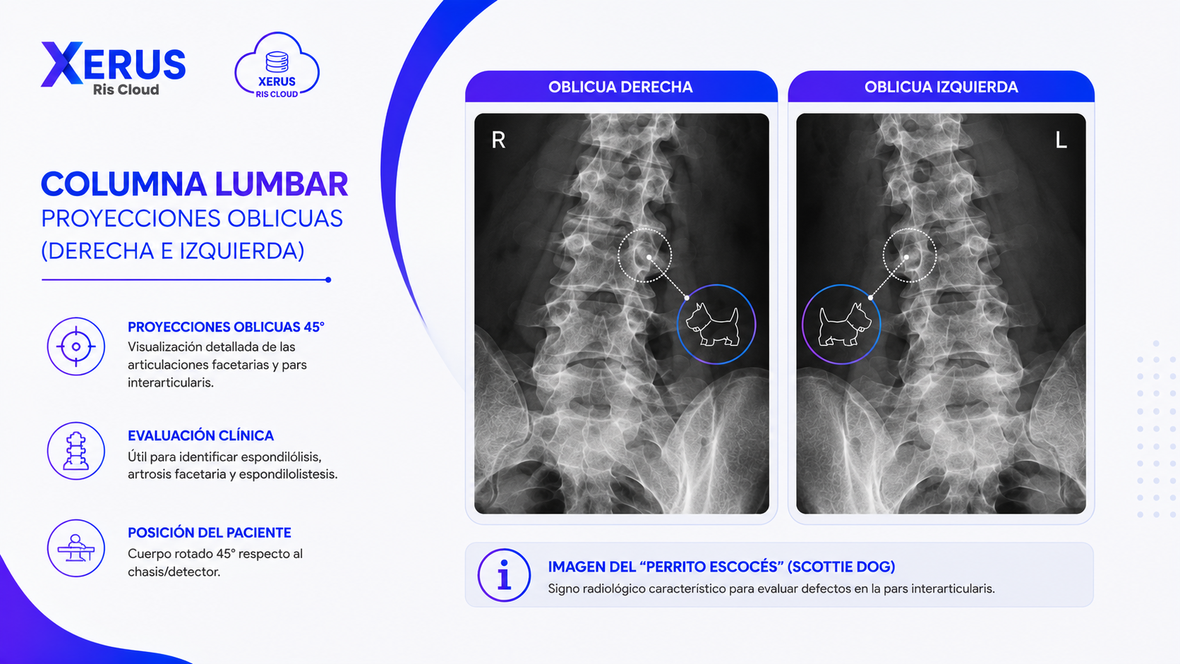 Radiografía de columna lumbar, proyecciones oblicuas (derecha e izquierda)