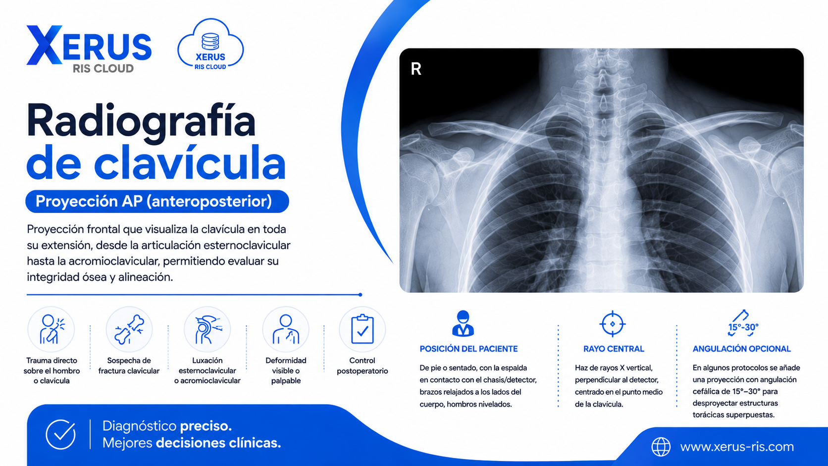 Radiografía de clavícula, proyección AP (anteroposterior).